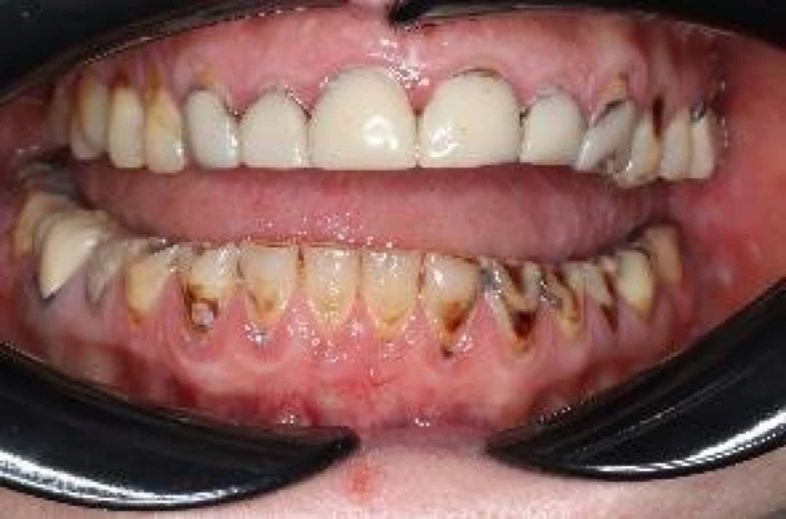 Full-mouth rehabilitation — baseline