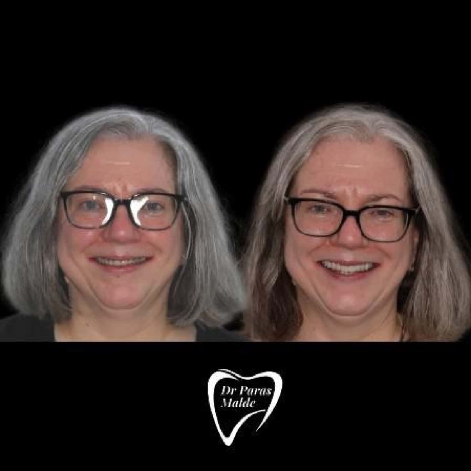 Full-mouth rehabilitation — the reveal