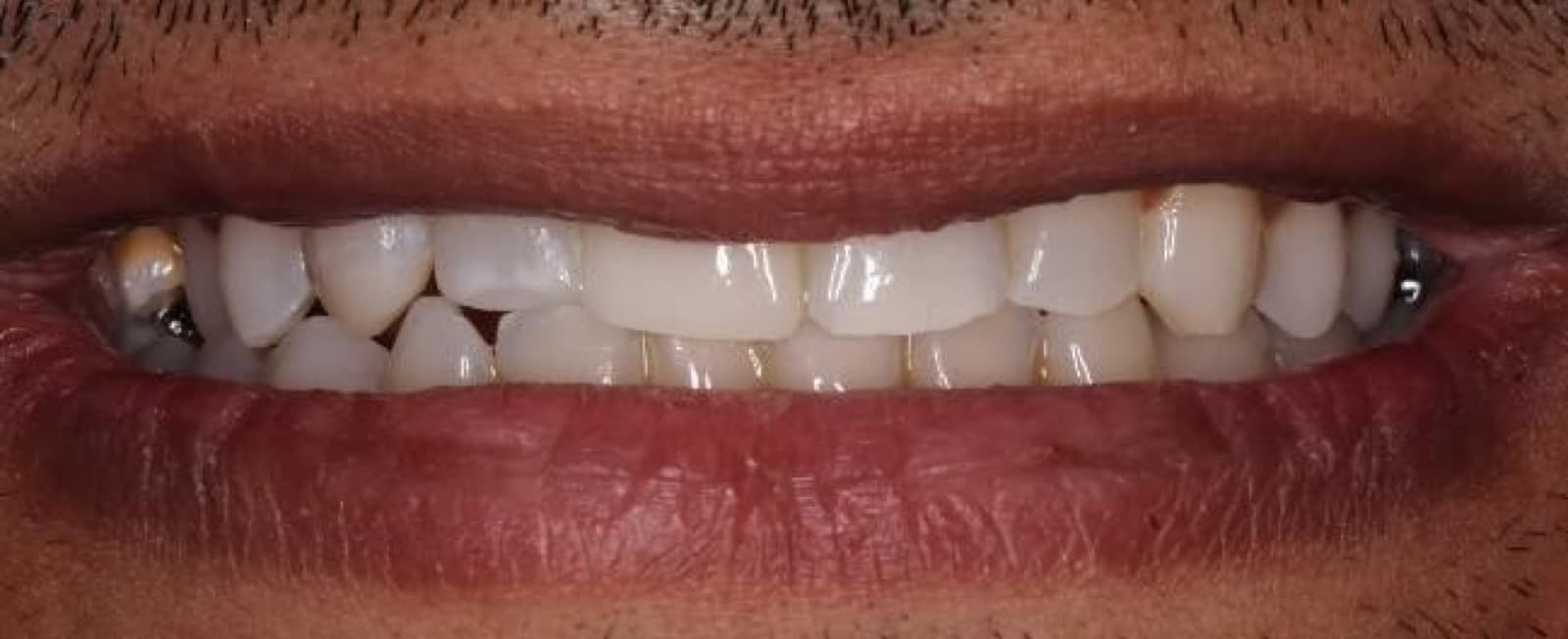 Veneer replacement with a full whitening refresh — after
