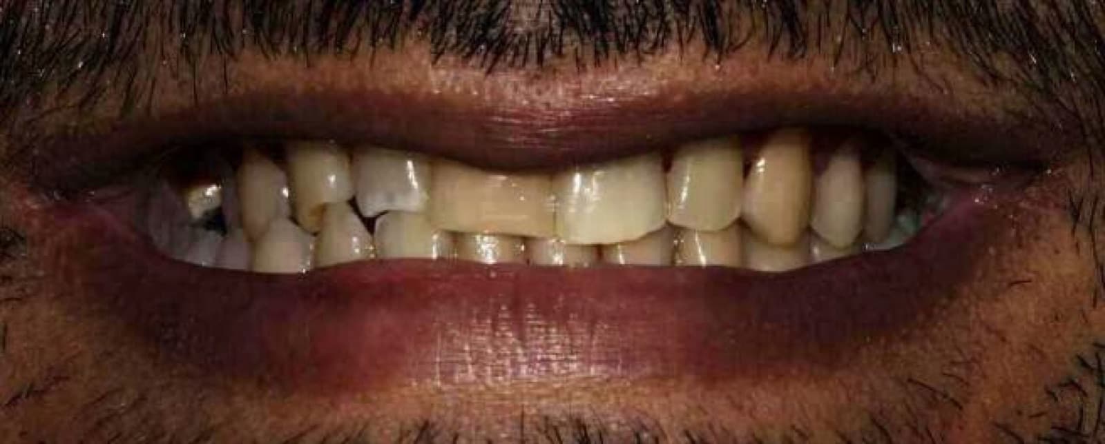Veneer replacement with a full whitening refresh — before