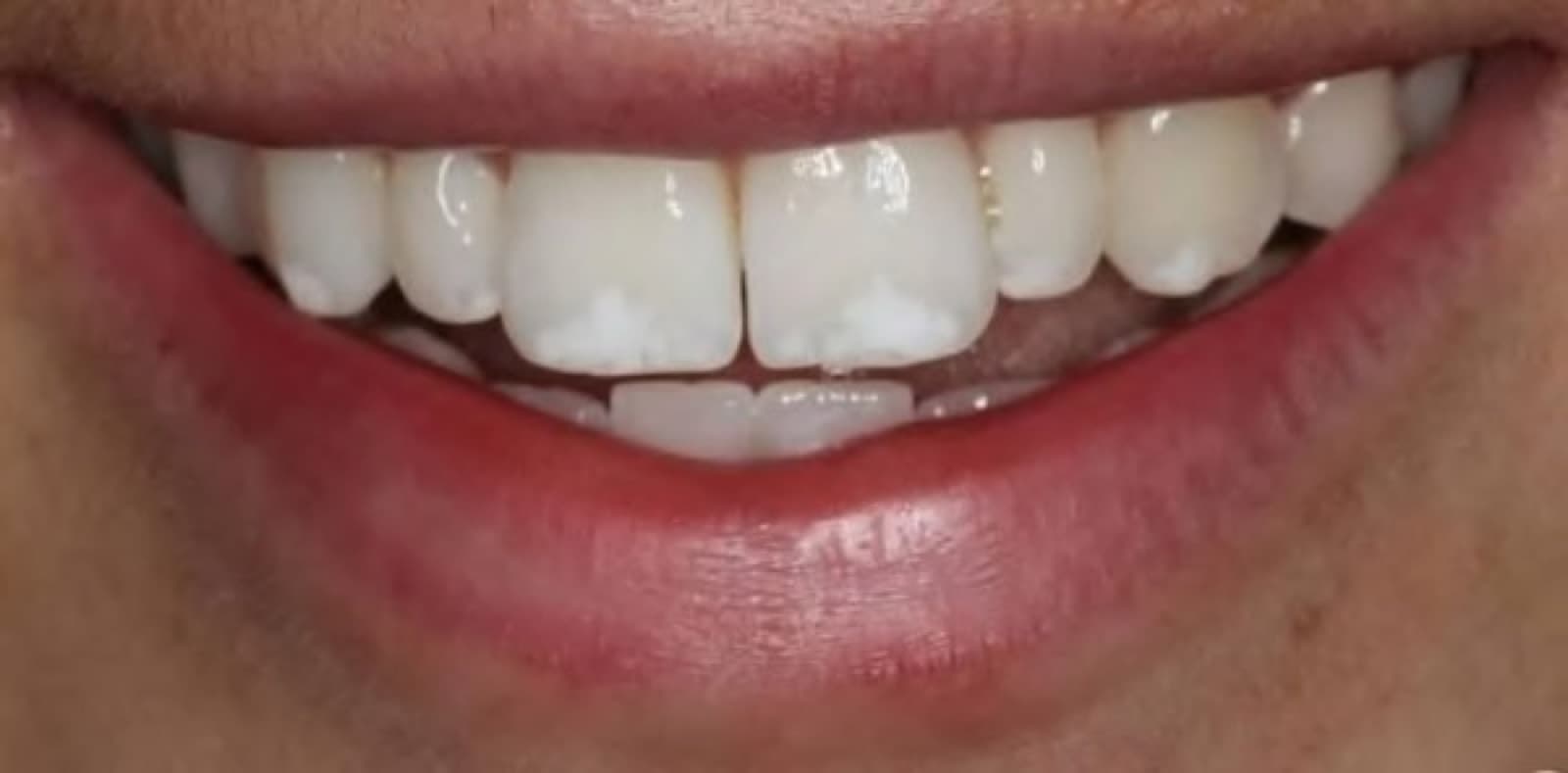 Removing white spot marks with resin infiltration and bonding — before