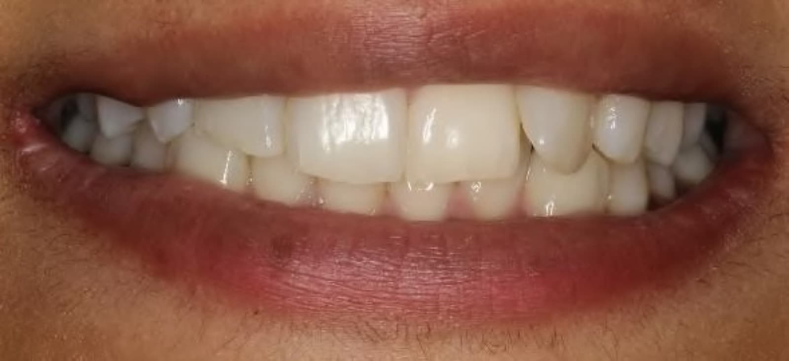 Invisalign finished with whitening and bonding — before