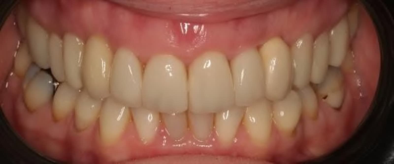 Anterior veneers, canine to canine — before
