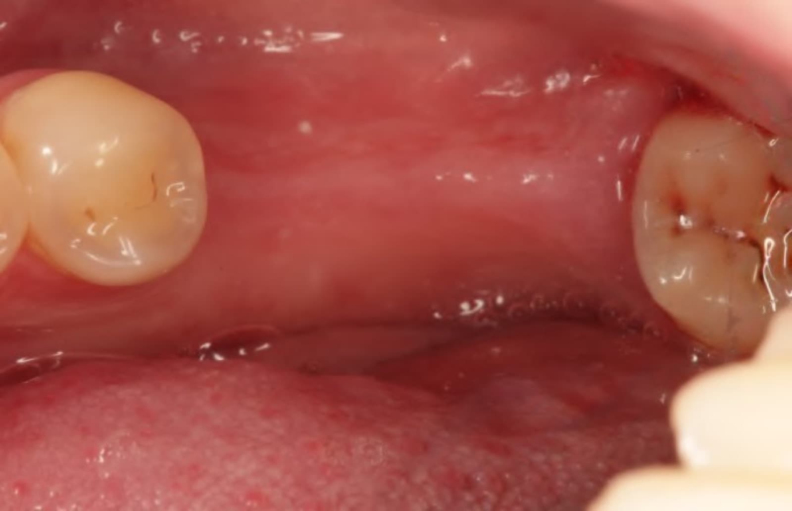 Implant-supported crown replacing a missing back tooth — before