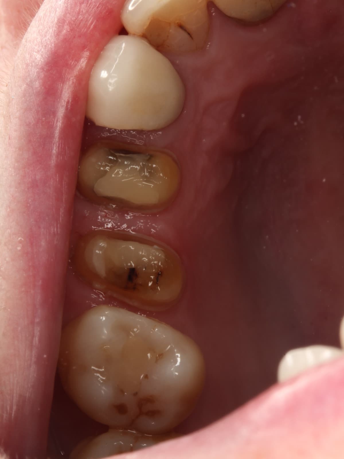 Old, decayed fillings replaced in tooth-coloured composite — before
