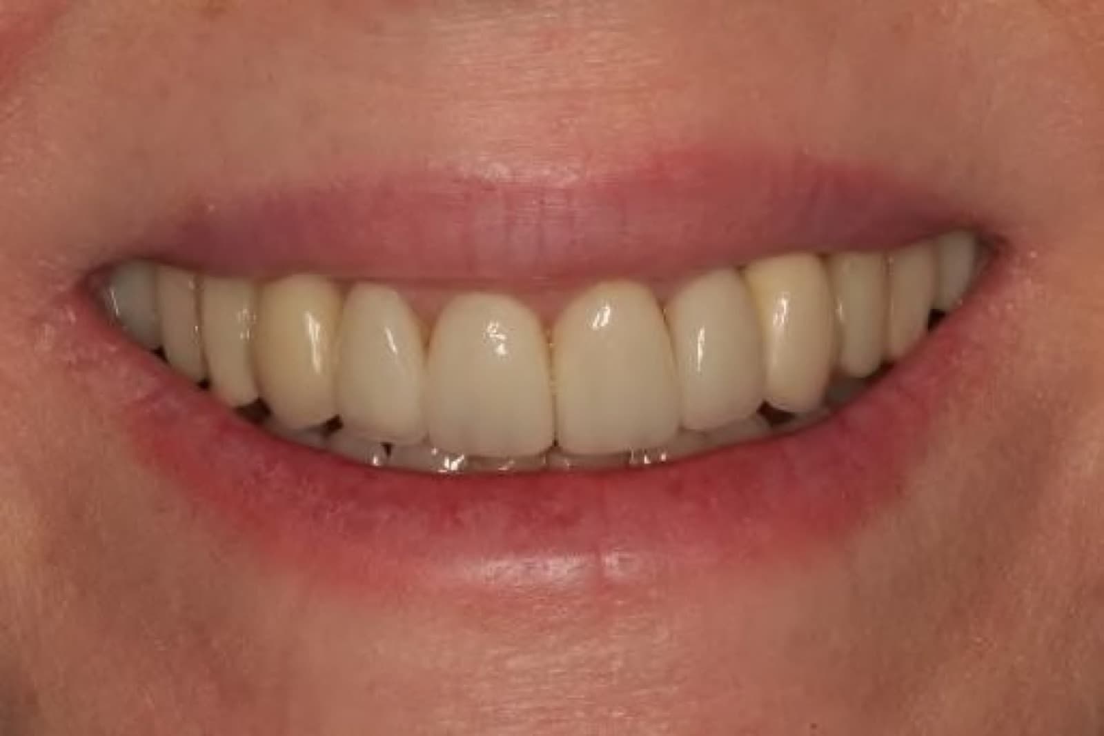 Anterior veneers, canine to canine — after