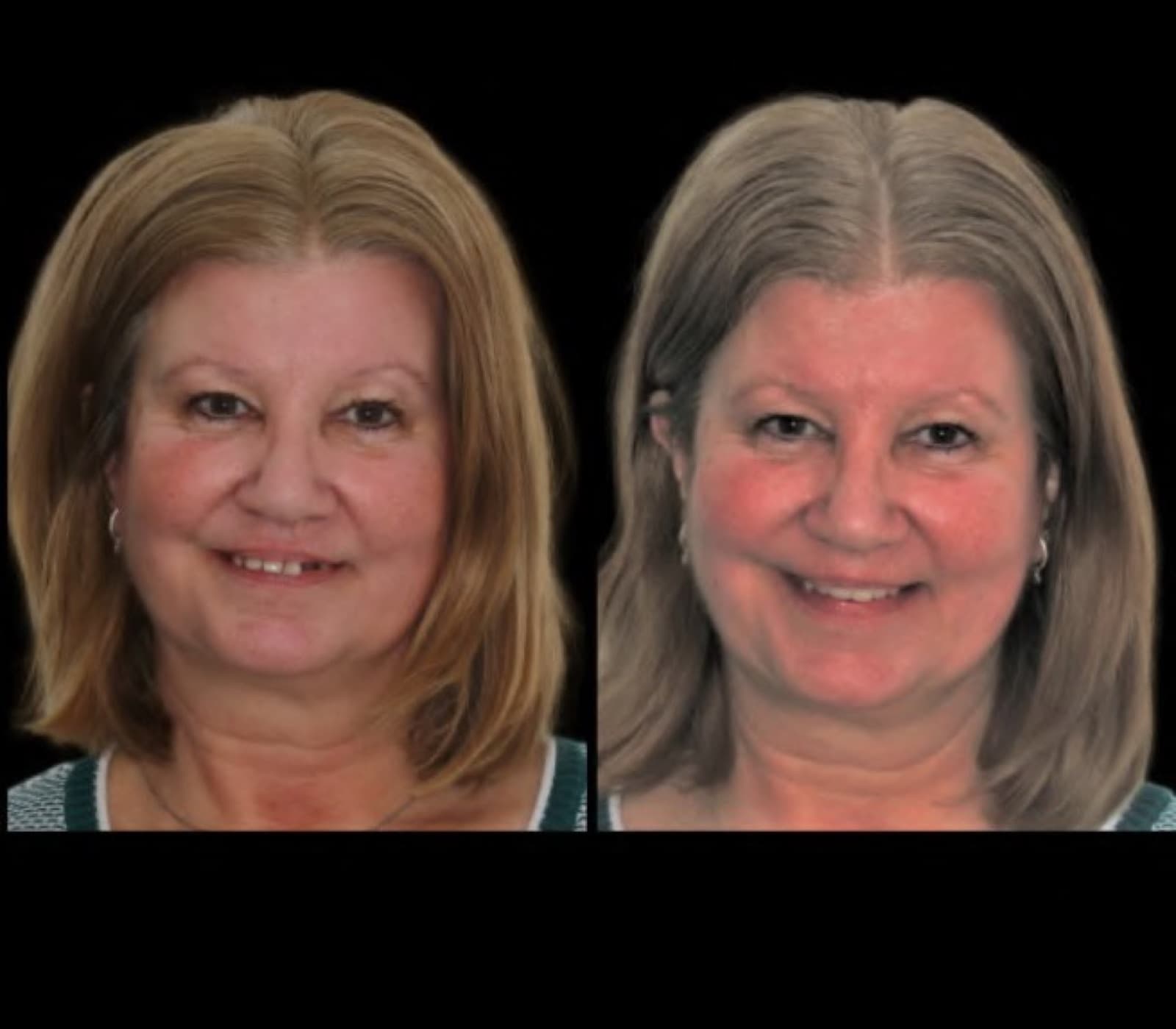Complete immediate denture smile transformation