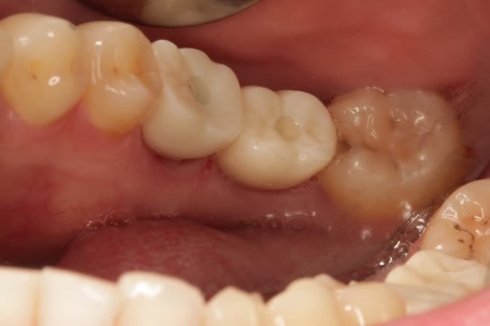 Implant-supported crown replacing a missing back tooth — after