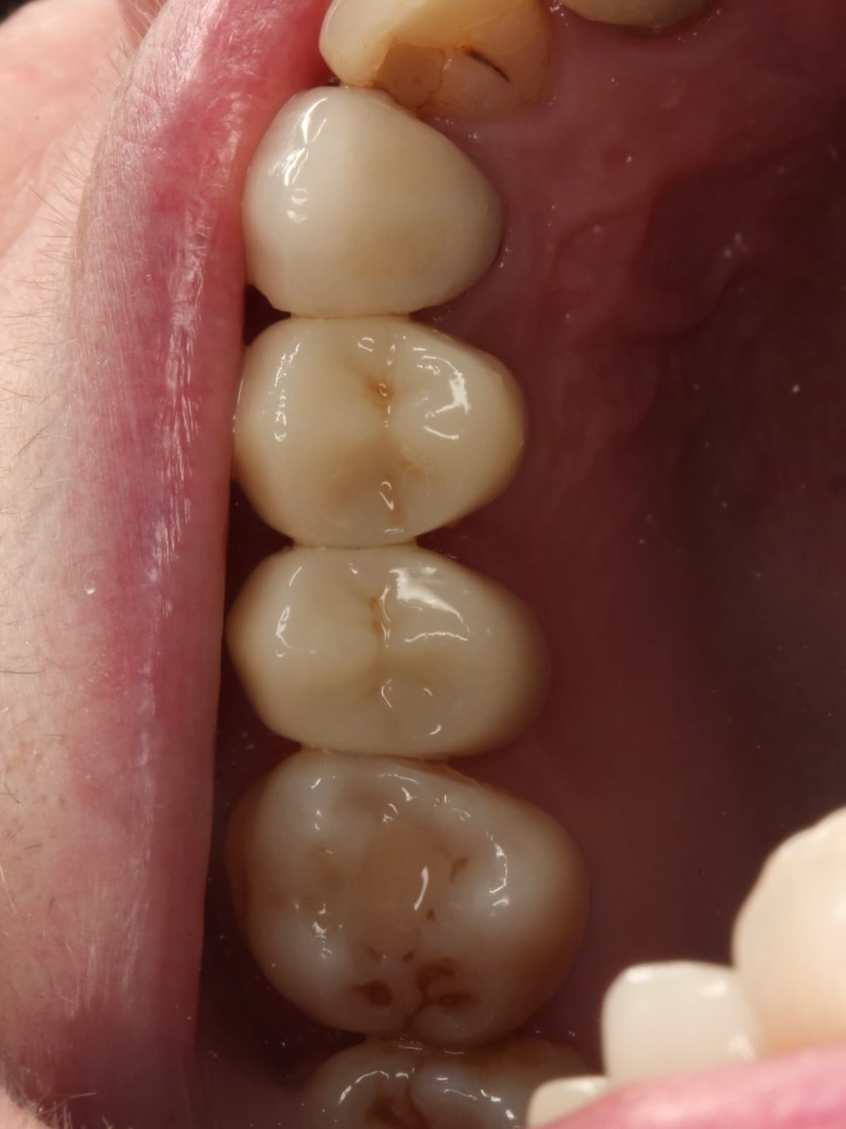 Old, decayed fillings replaced in tooth-coloured composite — after